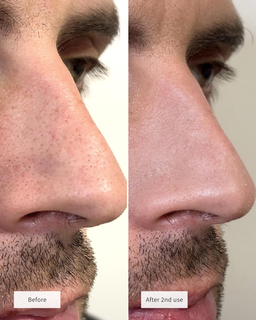 CLEAR PORE DUO
